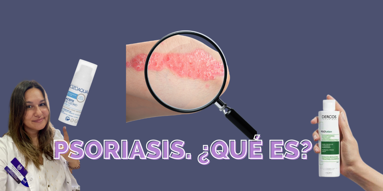 ¿Qué es la Psoriasis? Tipos y Tratamiento