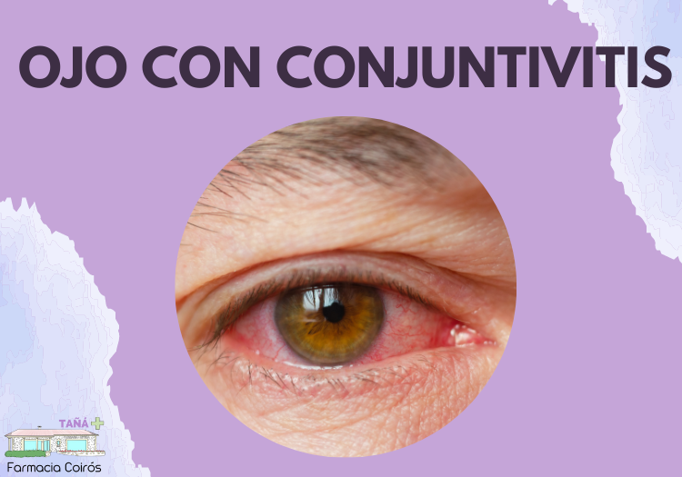 Imagen de ojo con conjuntivitis
