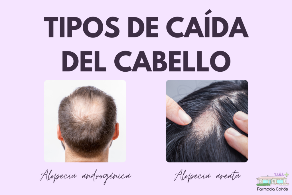 alopecia androgénica y alopecia areata